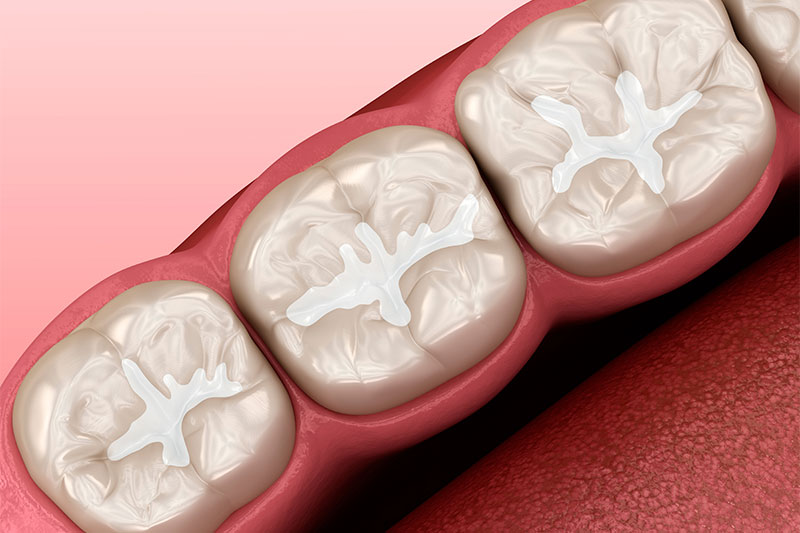 Dental Bonding in Prosper